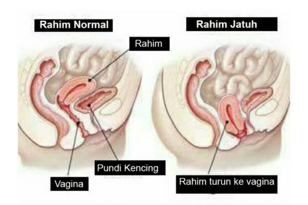 Ini Petanda Rahim Tak Sihat, Awas Jangan Biar Sampai Peranakan Jatuh!