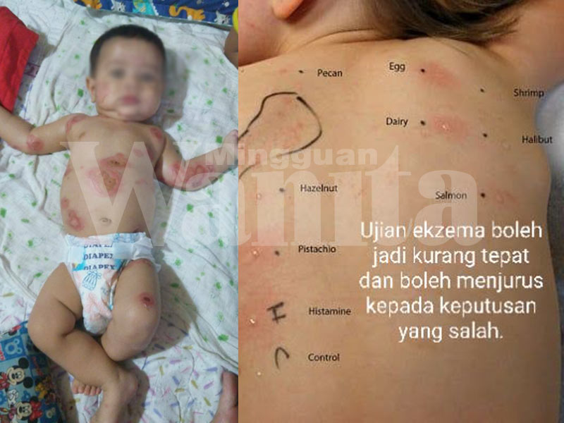 3 Sebab Ekzema Sukar Pulih, Mak Ayah Sila Baca Sebelum Kulit Anak Makin Teruk!