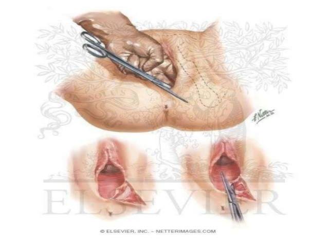 Doktor Ini Berikan Tip Elak Luka Bersalin Jadi Teruk & Pesan Cara Terbaik Jaga Luka Episiotomy