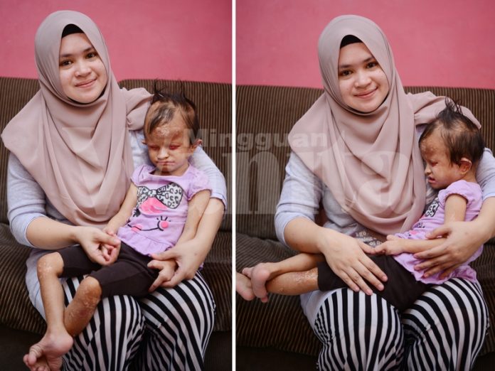 Untitled design(18) Anak Ini Lahir Tanpa Bebola Mata, 3 Lubang Di Jantung Dan Kesan Terbakar Pada Tubuh