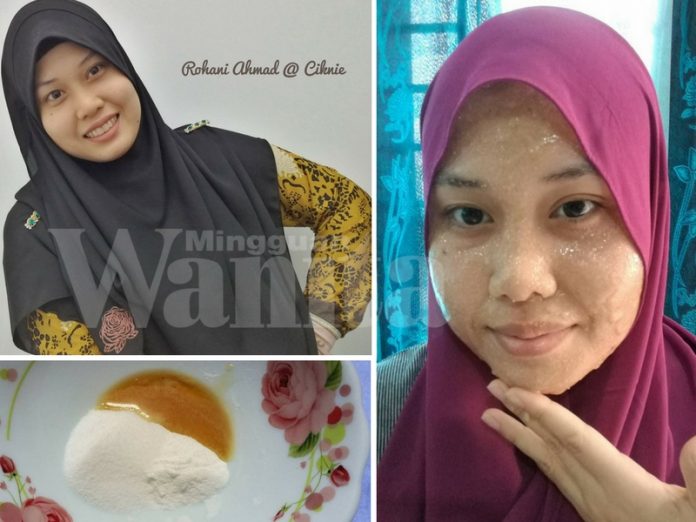 Ada 5 Cara Lenyapkan Blackhead Dan Jerawat Guna Baking Soda