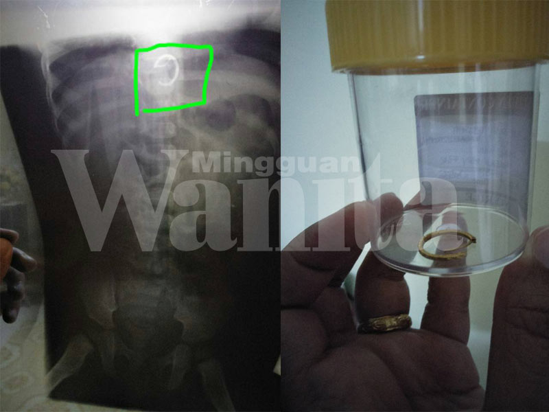 Bayi Tertelan Anting-anting, Macam Nak Gugur Jantung Mama Ini Bila Doktor Kata Kena Bedah Perut Anaknya