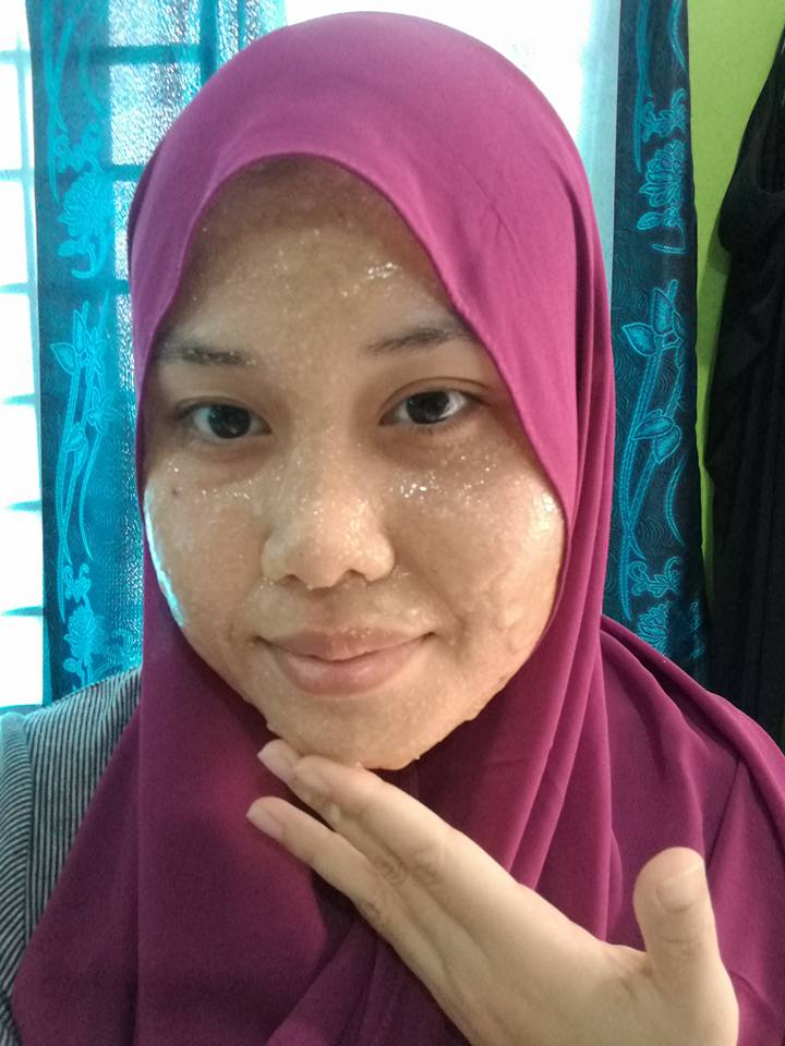 Ada 5 Cara Lenyapkan Blackhead Dan Jerawat Guna Baking Soda