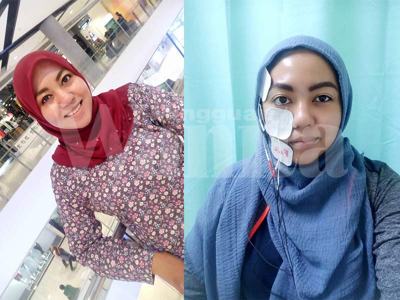 Lumpuh Sebelah Muka, Wanita Ini Dedah Punca Dan Cara Rawatan Strok Buat Anda Yang Senasib Dirinya