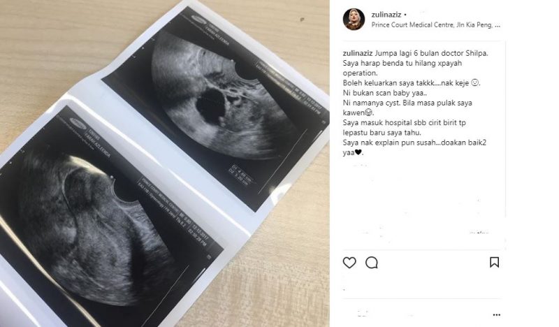 Zulin Aziz Dikesan Ada Cyst, Harap Ia Mengecut & Tak Perlu Jalani Pembedahan Dalam Masa 6 Bulan