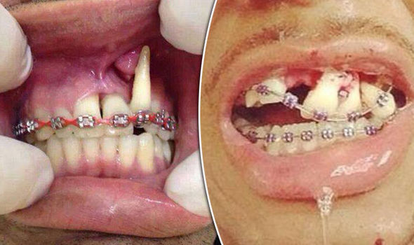 Akibat Pakai Fake Braces, Buka Besi Dekat Gigi Pun Pakai Pengetip Kuku!