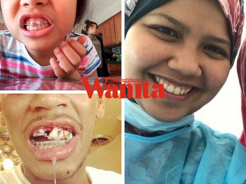 Akibat Pakai Fake Braces, Buka Besi Dekat Gigi Pun Pakai Pengetip Kuku!